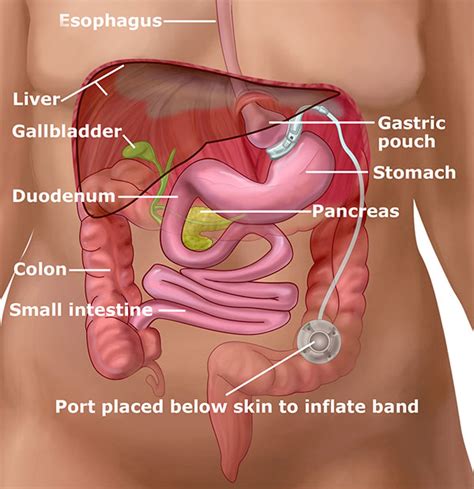 Laparoscopic Adjustable Gastric Band Surgery