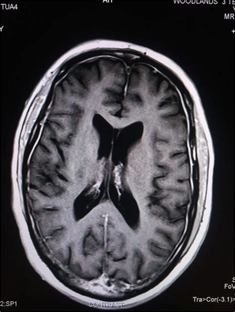 Figure 1b. MRI of brain revealed features of pachymeningitis : A ...