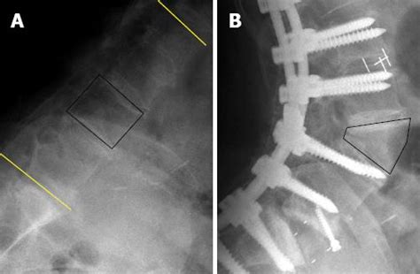 Spinal pedicle subtraction osteotomy for fixed sagittal imbalance patients