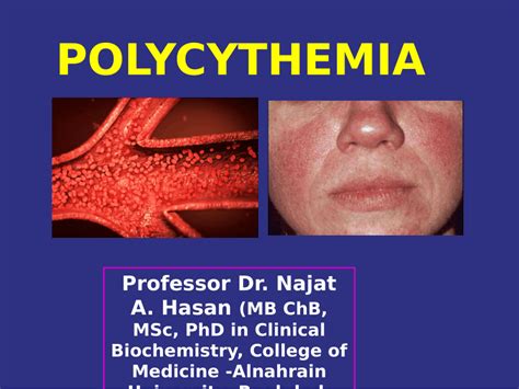 (PDF) polycythemia