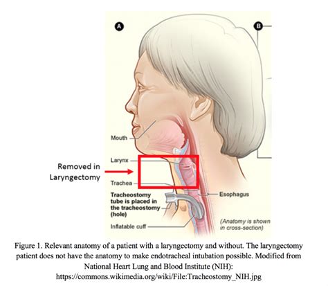 emDOCs.net – Emergency Medicine EducationTrach Travails: Need-to-Know ED Tricks for Airway ...