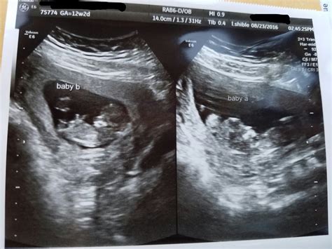 Surprised with identical twins at my 12 week ultrasound! : BabyBumps