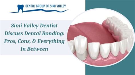 Simi Valley Dentist Discuss Dental Bonding Pros, Cons, & Everything In Between | PPT | Free Download