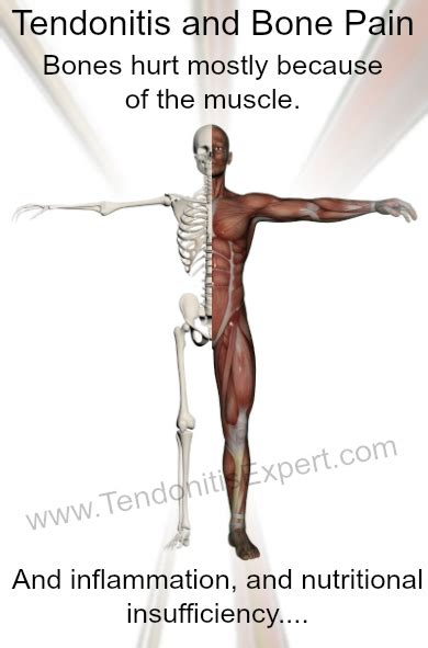 Bone Pain As A Cause Or Symptom Of Tendonitis