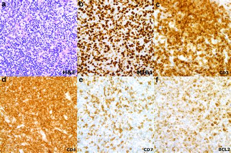 Right axillary lymph node biopsy at diagnosis. (a) Diffuse polymorphic... | Download Scientific ...