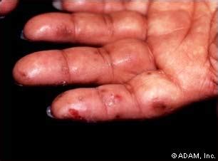 The New York Times > Health > Image > Dermatitis, Herpetiformis on the Hand