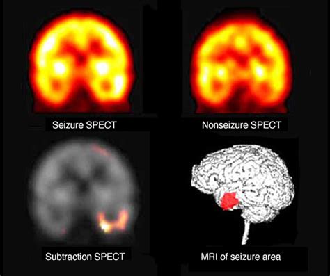 Grand Mal Seizure - Causes, Symptoms, After Effects, Recovery Time