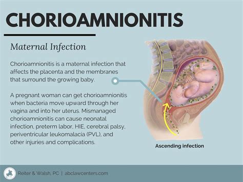 Signs of an Intrauterine Infection (Chorioamnionitis) | Pediatric ...