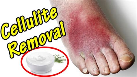 Cellulitis Treatment