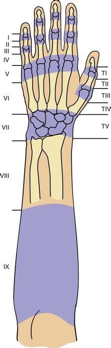 Hand Extensor Tendon Zones