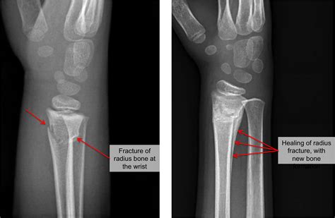 Buckle Fracture - Raleigh Hand Surgery — Joseph J. Schreiber, MD