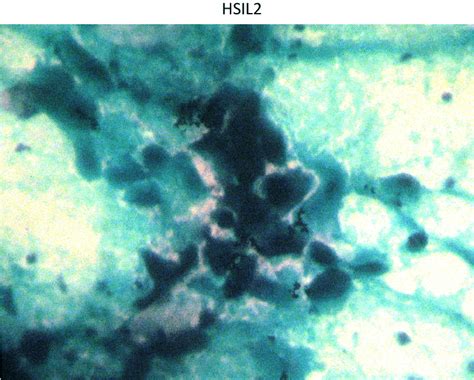 Photomicrograph of high-grade squamous intraepithelial lesion (HSIL ...