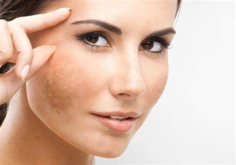 Tratamiento del melasma con ácido tranexámico: lo que necesitas saber