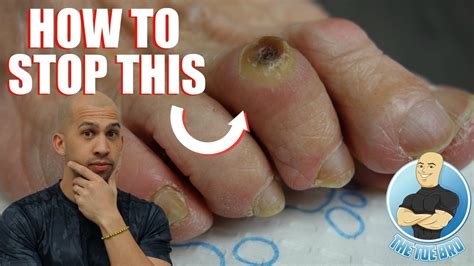 FOOT CORN REMOVAL FULL TREATMENT - FOOT HEALTH MONTH 2018 #3 - YouTube