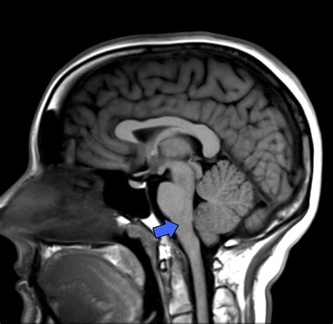 Brainstem Anatomy Mri