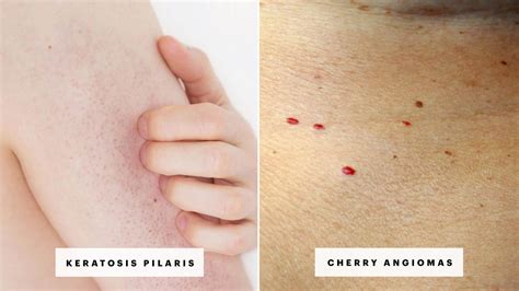 Cherry Angiomas - Beauty Photos, Trends & News | Allure