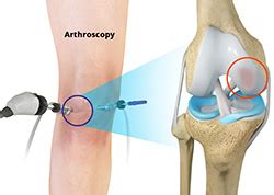 Chondroplasty Chandler, AZ | Shoulder Impingement Mesa, Queen Creek