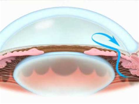 Laser for Narrow Angle Glaucoma - Part 1 - YouTube