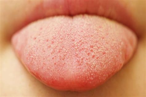 Lie Bumps - Causes, Symptoms, Treatment and Prevention