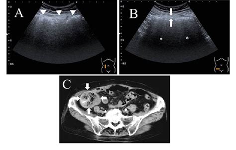 Sonographic Visualization of Fecal Loading in Adults | Semantic Scholar