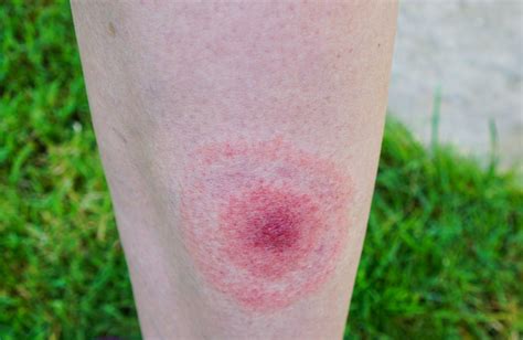 Lyme Disease: The Ultimate Guide - AmeriPharma Specialty Care