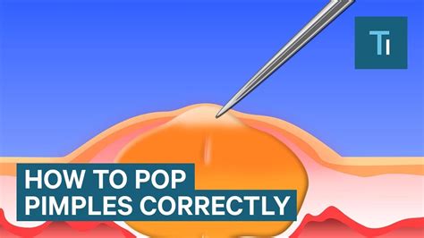 Popping Pimples Diagram