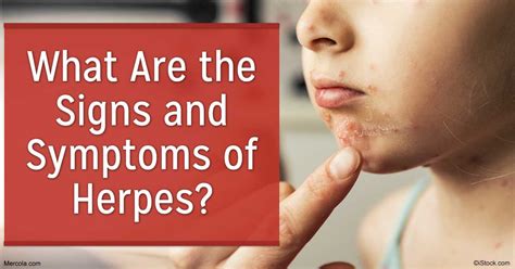 What Are the Signs and Symptoms of Herpes?