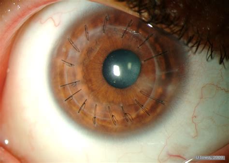 Keratoconus Surgical Options. EyeRounds.org - Ophthalmology - The University of Iowa