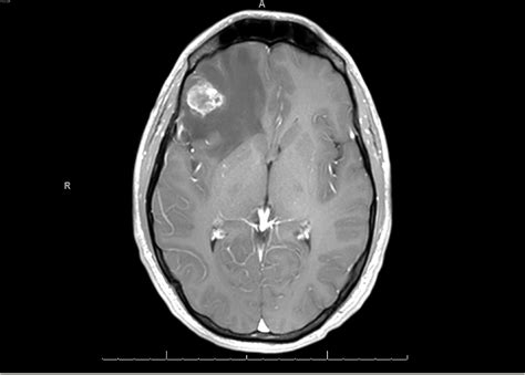 Cureus | Brain Metastases as Presenting Feature in 'Burned Out' Testicular Germ Cell Tumor