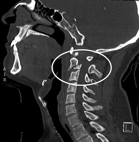 Cervical spine hangman fracture secondary to a gelastic seizure | BMJ ...