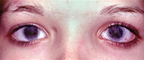 Abnormal pupils and iridal hypoplasia with the Rieger syndrome (Case 4 ...