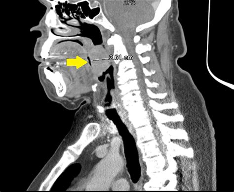 Tonsil Ct Scan