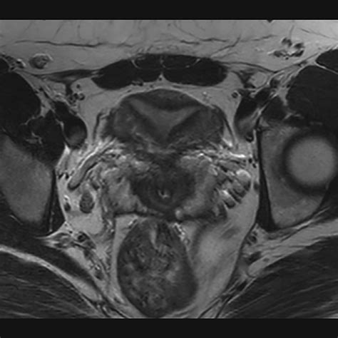 -Axial T2 MRI. No evidence for vaginal septum, atresia or uterus didelphys. | Download ...