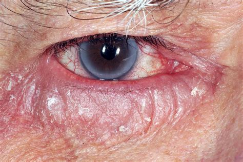 Allergic eye disease | The BMJ