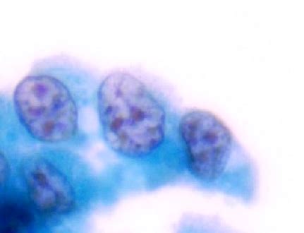 Atypical Urothelial Cells in Urine Symptoms, Causes, Treatment