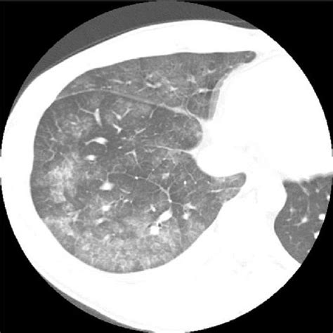 (PDF) Eosinophilic pneumonia: A review of the previous literature ...