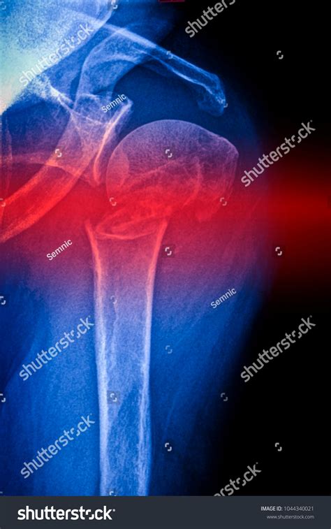 Shoulder Fracture X Ray Image Stock Photo 1044340021 | Shutterstock