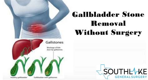 Myths and Reality of Gallstone Treatment and Gallbladder Removal