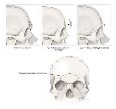 What is Forehead Reduction (Contouring or Reshaping) Surgery? Facial Feminization (FFS)