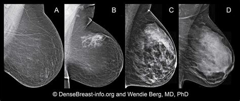 What Causes Scattered Fibroglandular Densities | Renew Physical Therapy