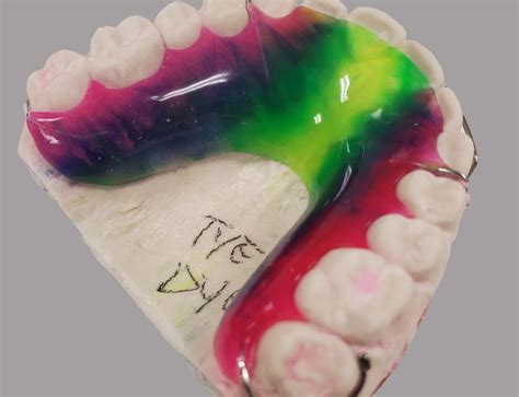 Retainers – Sanders Orthodontic Lab
