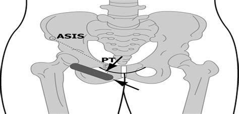 Obturator Nerve Block Using Ultrasound Guidance : Anesthesia & Analgesia