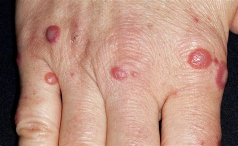 Case Report: Skin Mottling Linked to Infection - Dermatology Advisor