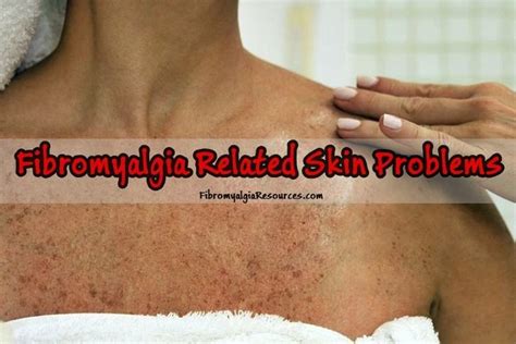 Fibromyalgia Related Skin Problems and their Managment | Fibromyalgia ...