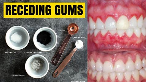 Receding Gums Cure