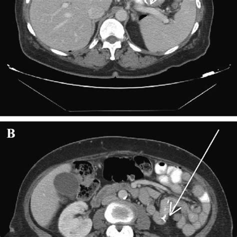 Case 2: gastrojejunal anastomosis with contrast extravasation (a) and ...