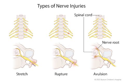 Brachial Plexus Birth Injury | Boston Children's Hospital