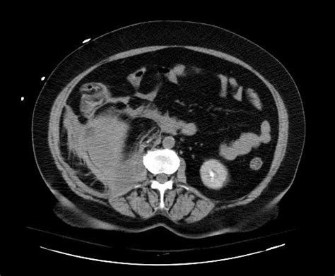 Retroperitoneal hematoma - wikidoc