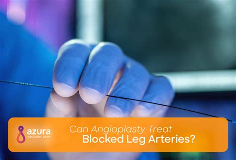 Angioplasty Procedure and PAD | Treat Blocked Leg Arteries