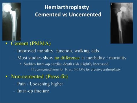 Role of hemiarthroplasty -30th aug 2015